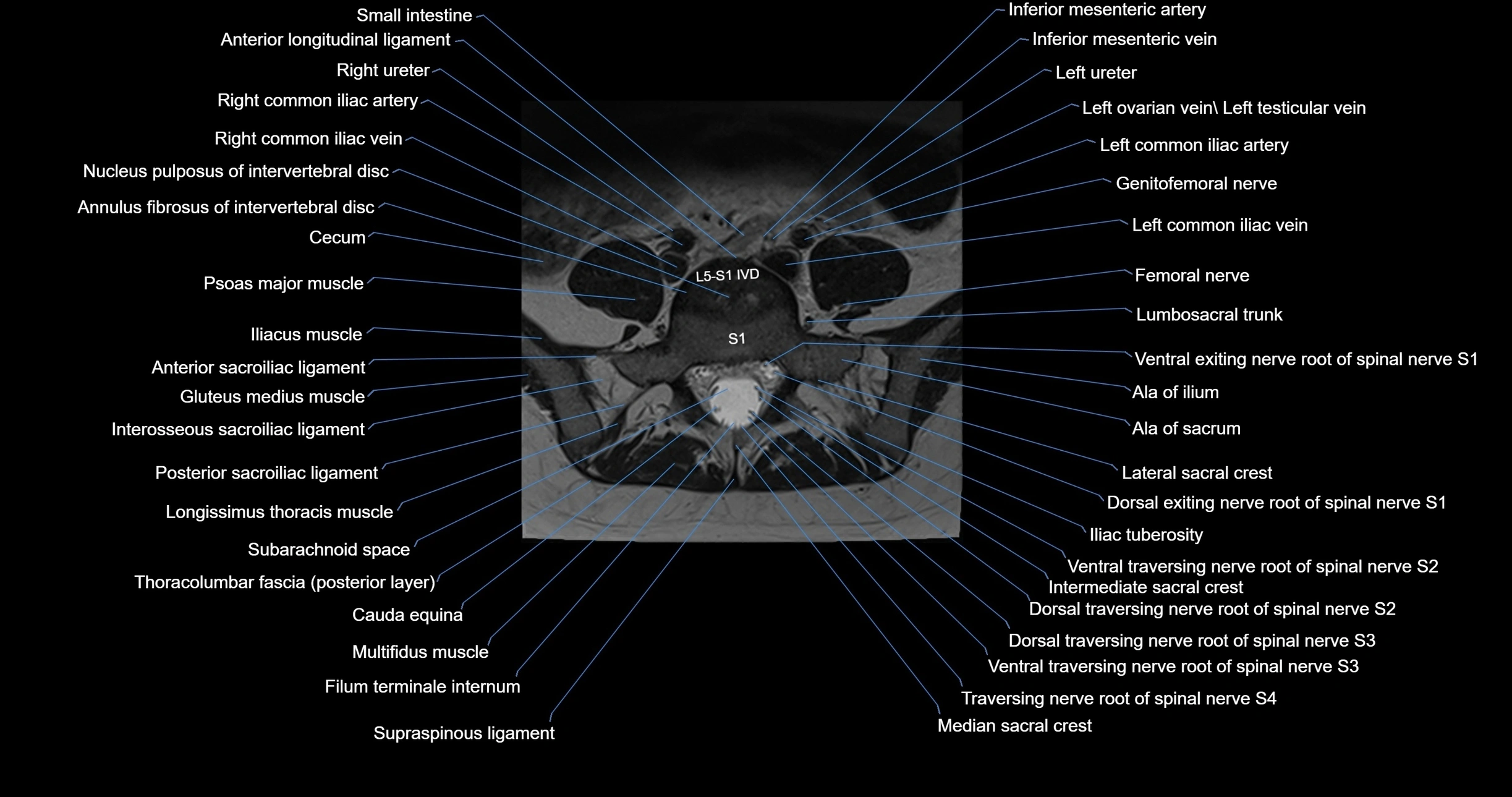 MRI lumbar spine axial cross sectional anatomy 3T radiology  image-img-00001-00043.webp
